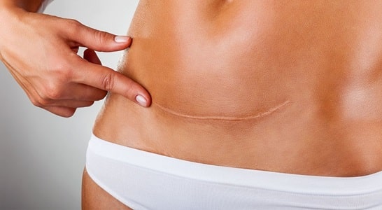 Tummy Tuck Scars